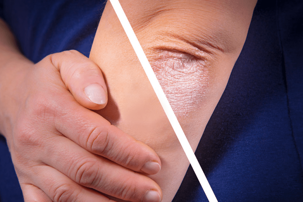 The Relationship Between Skin Barrier Dysfunction and Psoriasis