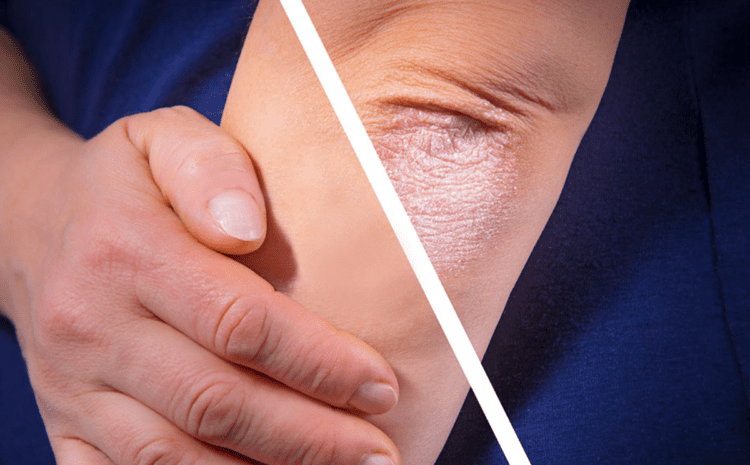 The Relationship Between Skin Barrier Dysfunction and Psoriasis